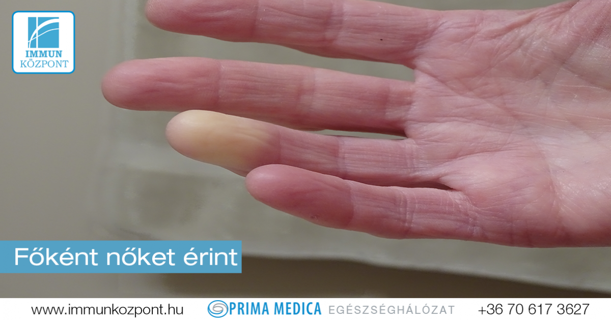 Főként nőket érint: a Raynaud-jelenség - Raynaud-kór és ízületek