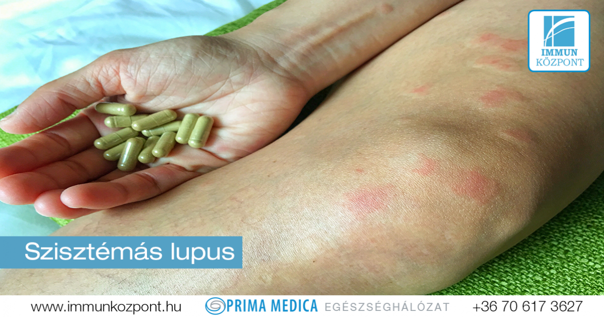 SLE - Szisztémás lupus erythematosus Ízületi fájdalom lupussal