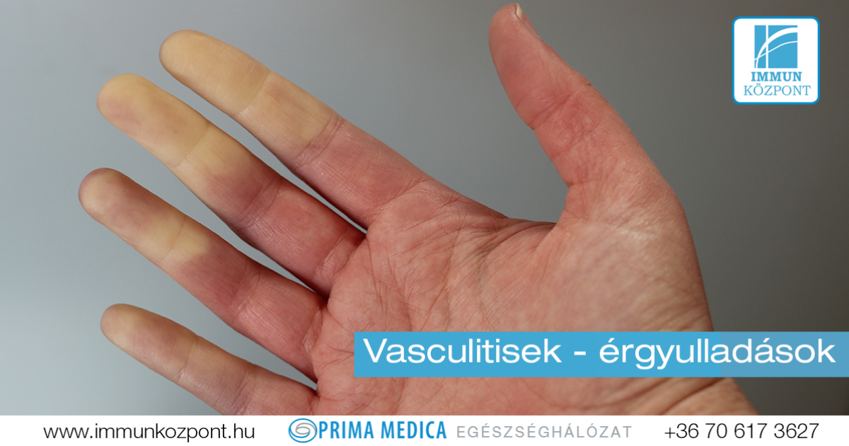 A Raynaud-betegség természetes gyógymódjai | Gyógyszer Nélkül