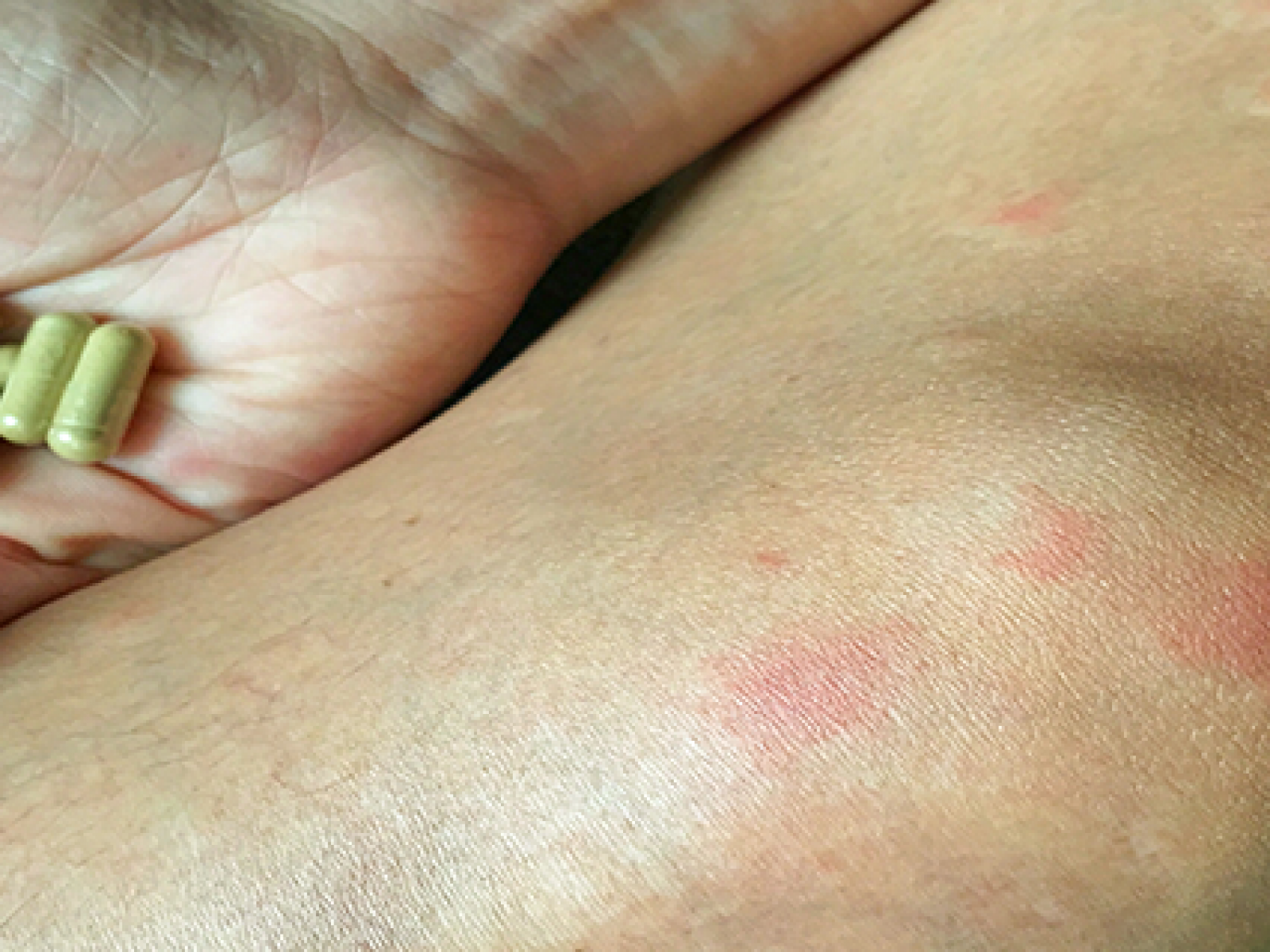 SLE - szisztémás lupus erythematosus