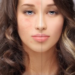 Kiütések, bőrpír az arcon: autoimmun betegség jele is lehet