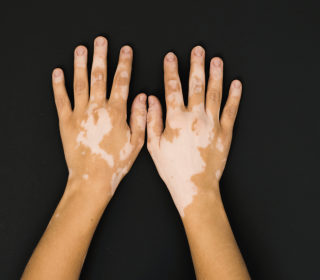 Vitiligo