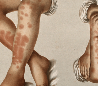 Erythema nodosum