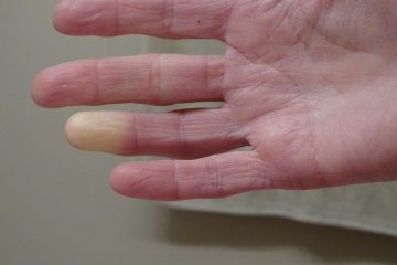 5 dolog, amiről felismerheti a Raynaud-szindrómás beteget!