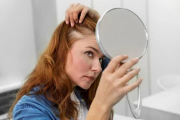 Alopecia areata – foltos hajhullás