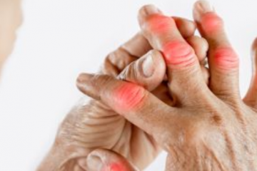 Reumás ízületi gyulladás - csak a szteroid segíthet?