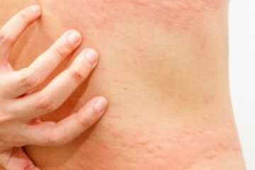 Bőrtünetek, amelyek immunológiai betegségre utalhatnak 