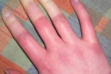 Főként nőket érint: a Raynaud-jelenség