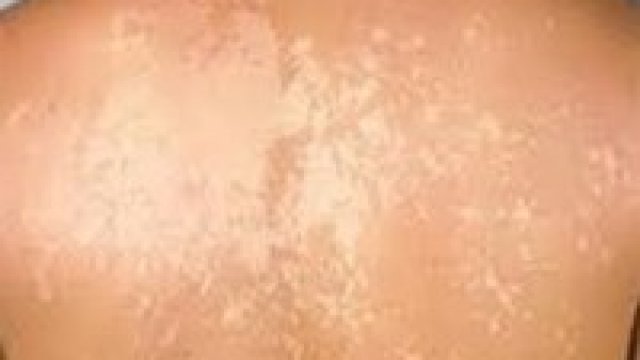 Vitiligo és társbetegségei