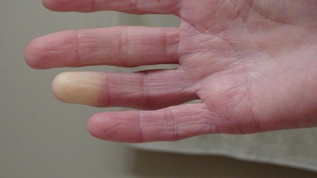5 dolog, amiről felismerheti a Raynaud-szindrómás beteget!