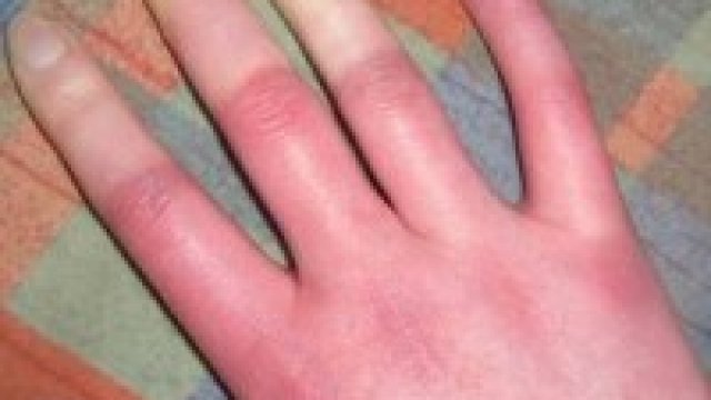 Főként nőket érint: a Raynaud-jelenség