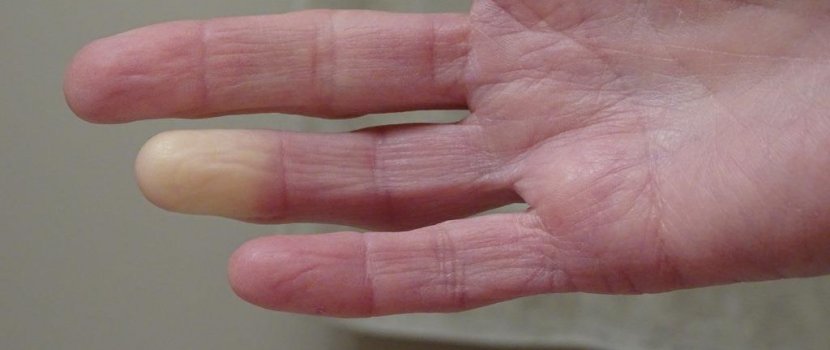 5 dolog, amiről felismerheti a Raynaud-szindrómás beteget!