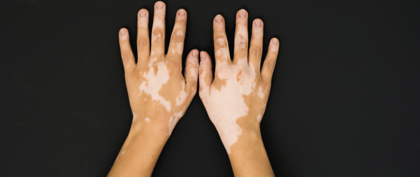 Vitiligo