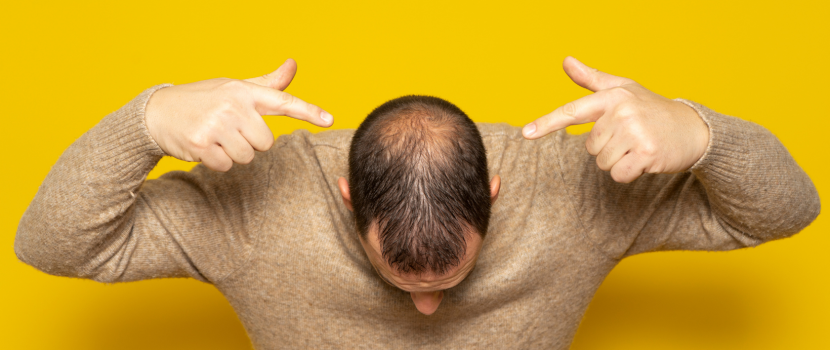 Alopecia-