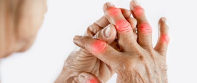 Reumás ízületi gyulladás - csak a szteroid segíthet?