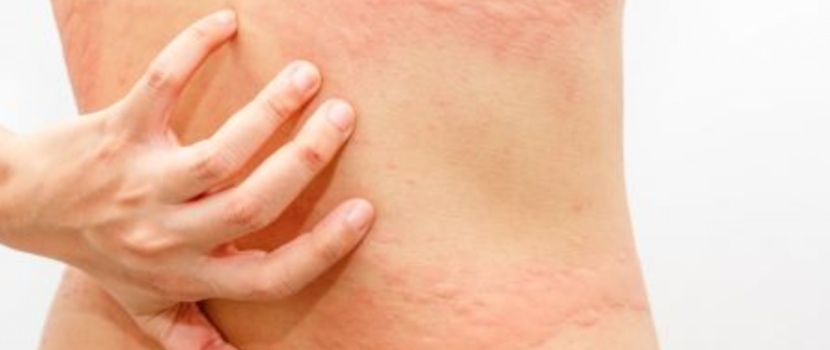 Bőrtünetek, amelyek immunológiai betegségre utalhatnak 