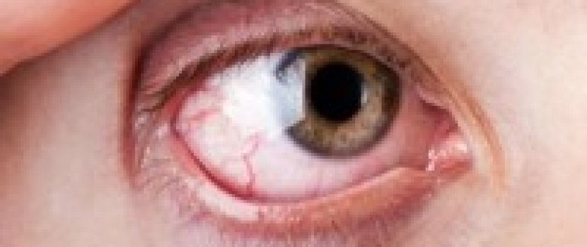 ízületi fájdalom vörös szem