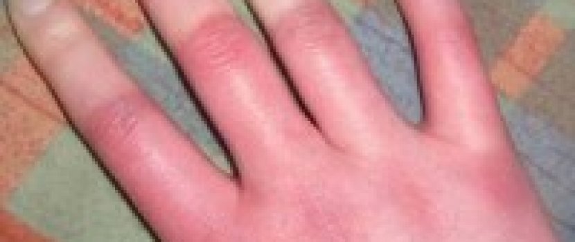 Raynaud ízületi fájdalom szindróma