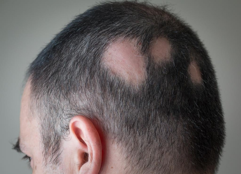 Az alopecia areata autoimmun betegség tünete a foltos hajhullás.
