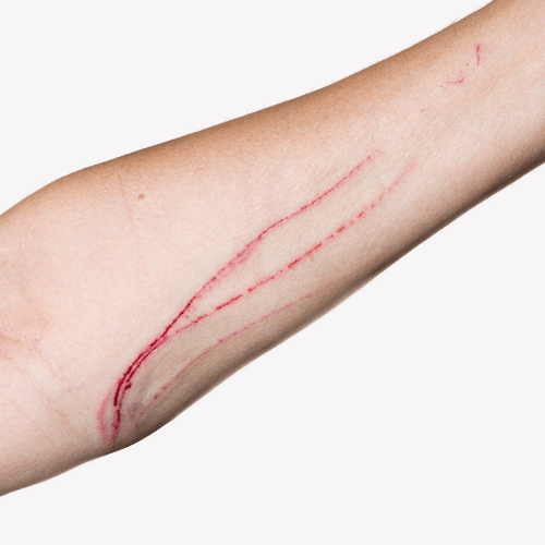 bartonella