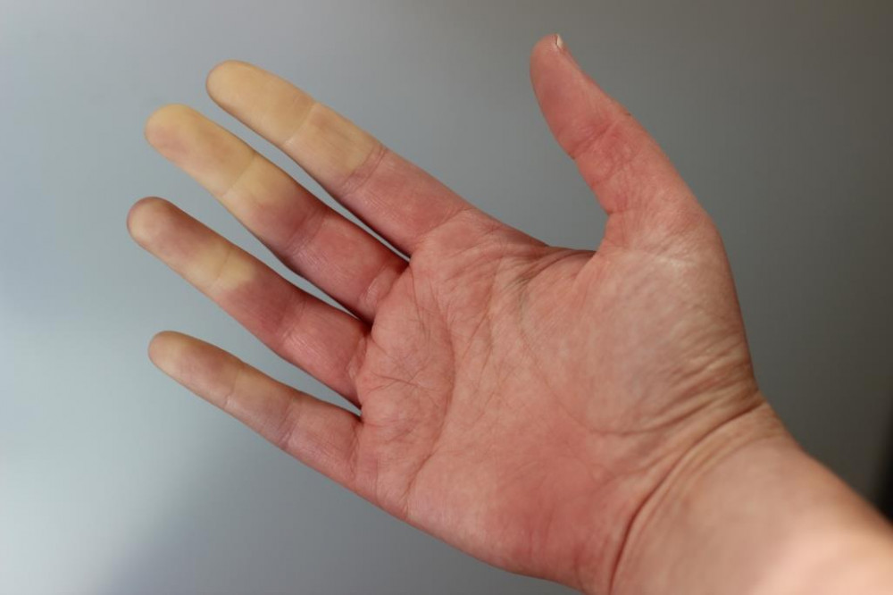 A Raynaud-jelenség is lehet scleroderma tünete.