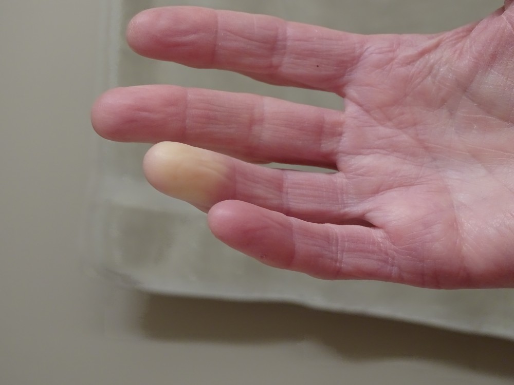 Az ujjak megvastagodnak, az érintettek feszítő érzésről panaszkodnak, a bőr fényes, vagy viaszszerűvé válik.