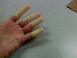 raynaud-szindróma immunközpont