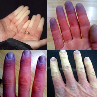 Hidegben elfehéredő ujjak: Raynaud-kór és Raynaud-szindróma