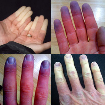 raynaud ízületi fájdalom szindróma
